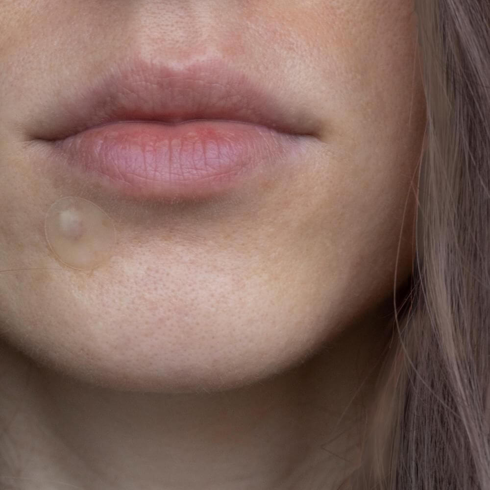 Pimple Patches mod bumser — Effektive Bumse Plastrer med hyaluronsyre & salicylsyre Online