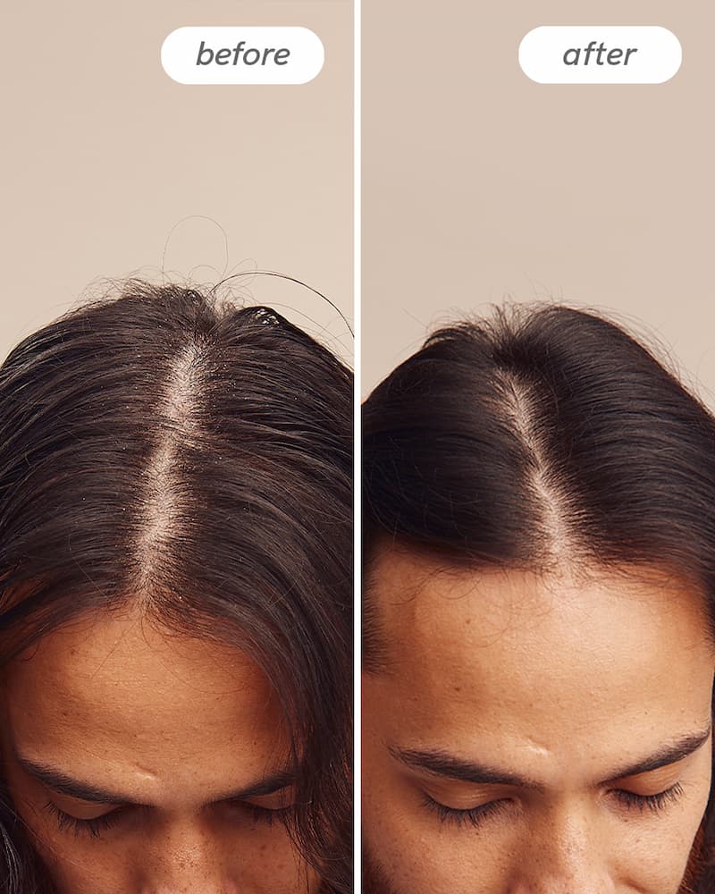 Instant Relief™ Dandruff Shampoo